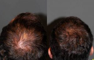 before after photo of a mans hair after undergoing a procedure