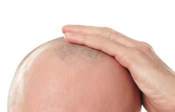 older man rubbing top of his bald head