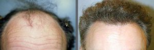 Before and after one hair transplant using the follicular unit extraction method of hair transplantation with NeoGraft, one session of 3000 hair grafts. -