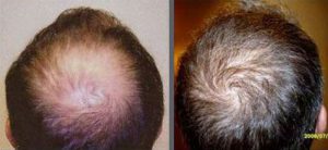 Before and after one hair transplant using the follicular unit extraction method of hair transplantation with NeoGraft, one session of 2000 hair grafts. -