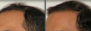 Time elapse of hair transplant session using grafts by follicular grafting using the thin strip method. -