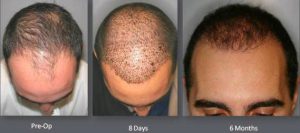 Time elapse of male hair transplant using NeoGraft. -