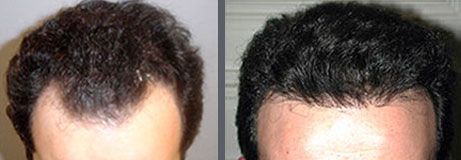 Before and after one hair transplant using the follicular unit extraction method of hair transplantation with NeoGraft, one session of 1500 hair grafts. -
