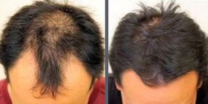 Before and after one hair transplant using the follicular unit extraction method of hair transplantation with NeoGraft, one session of 2000 hair grafts. -