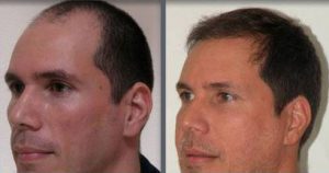 Before and after one hair transplant using the follicular unit extraction method of hair transplantation with NeoGraft, one session of 2000 hair grafts. -