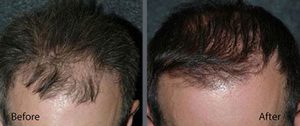 Before and after one hair transplant session of 1500 grafts by follicular grafting using the thin strip method. -