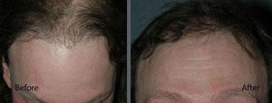 Before and after one hair transplant session of 1000 grafts by follicular grafting using the thin strip method. -