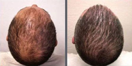 Before and after one hair transplant using the follicular unit extraction method of hair transplantation with NeoGraft, one session of 2000 hair grafts. -