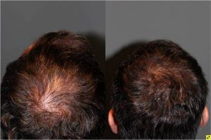 36 year old male 9 months postop from Neograft FUE crown hair transplant restoration with 1200 grafts -