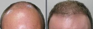 Before and after one hair transplant using the follicular unit extraction method of hair transplantation with NeoGraft, one session of 2500 hair grafts. -