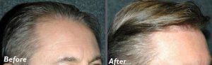 Before and after hair transplant session of 2000 grafts by follicular unit grafting using the thin strip method. -