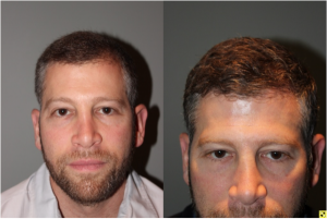 36 yo male 6 months after neograft hair transplant procedure with 1500 grafts- View 5 -