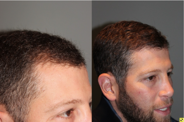 36 yo male 6 months after neograft hair transplant procedure with 1500 grafts- View 4 -