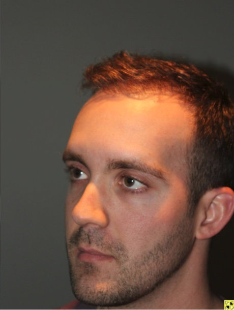 after photo from the left side