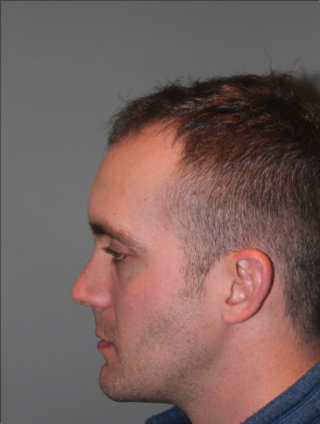 before photo from the left profile