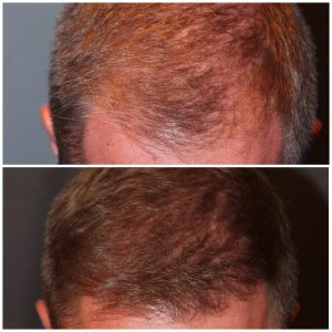 34 year old male 7 months post 2000 graft frontal hairline hair transplant. About 60% regrowth of what he will have at 18 months.