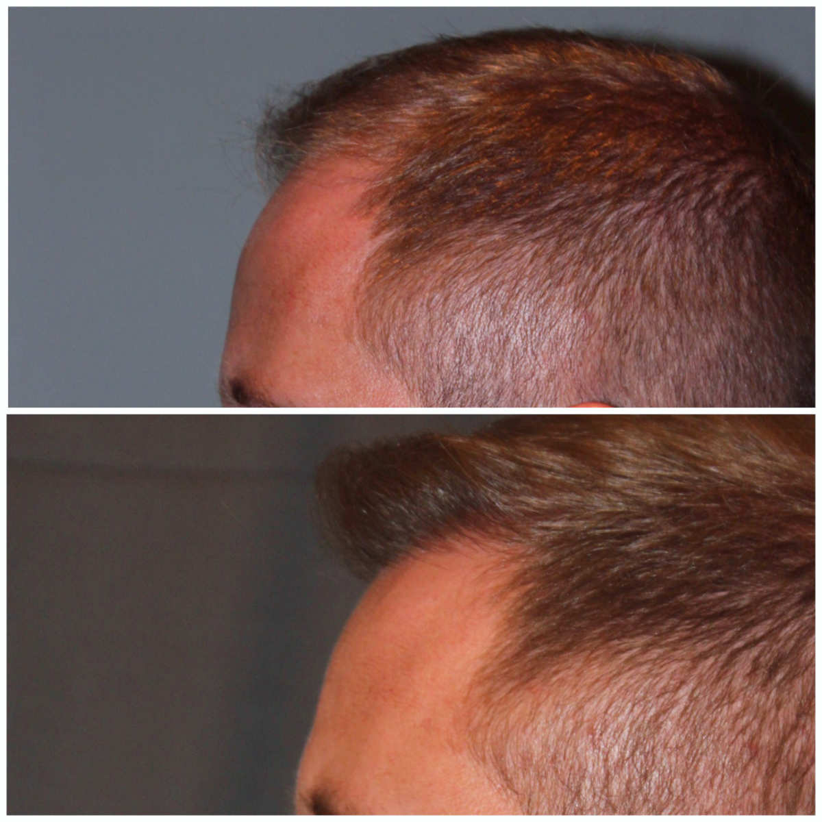 34 year old male 7 months post 2000 graft frontal hairline hair transplant. About 60% regrowth of what he will have at 18 months.