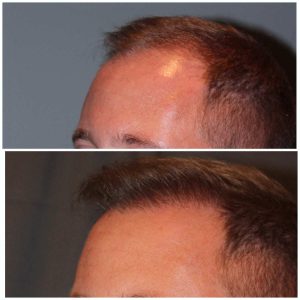 34 year old male 7 months post 2000 graft frontal hairline hair transplant. About 60% regrowth of what he will have at 18 months.