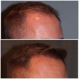34 year old male 7 months post 2000 graft frontal hairline hair transplant. About 60% regrowth of what he will have at 18 months.
