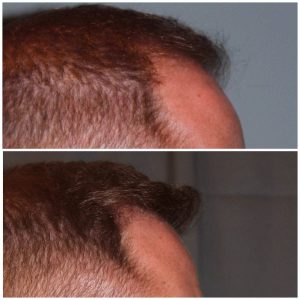 34 year old male 7 months post 2000 graft frontal hairline hair transplant. About 60% regrowth of what he will have at 18 months.