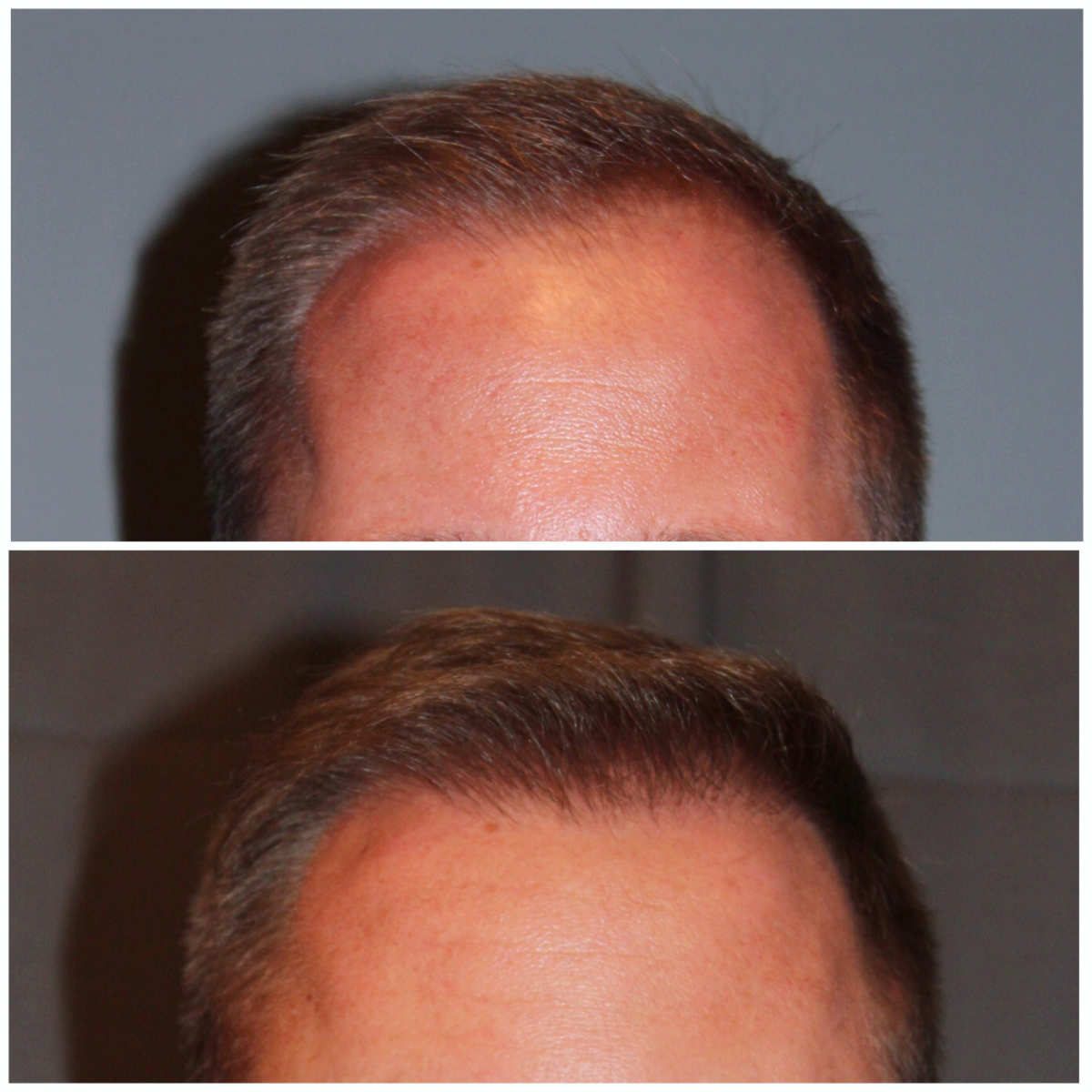 34 year old male 7 months post 2000 graft frontal hairline hair transplant. About 60% regrowth of what he will have at 18 months.