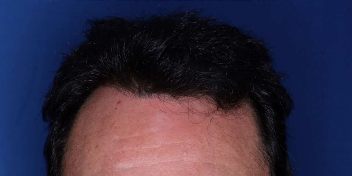 after the hair transplant