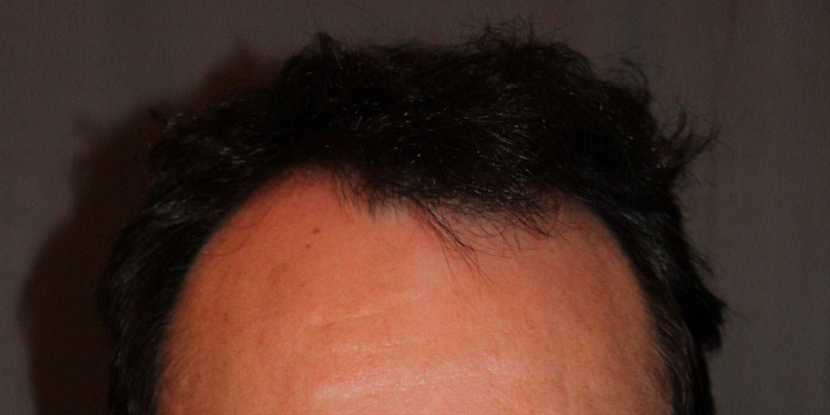 before the hair transplant