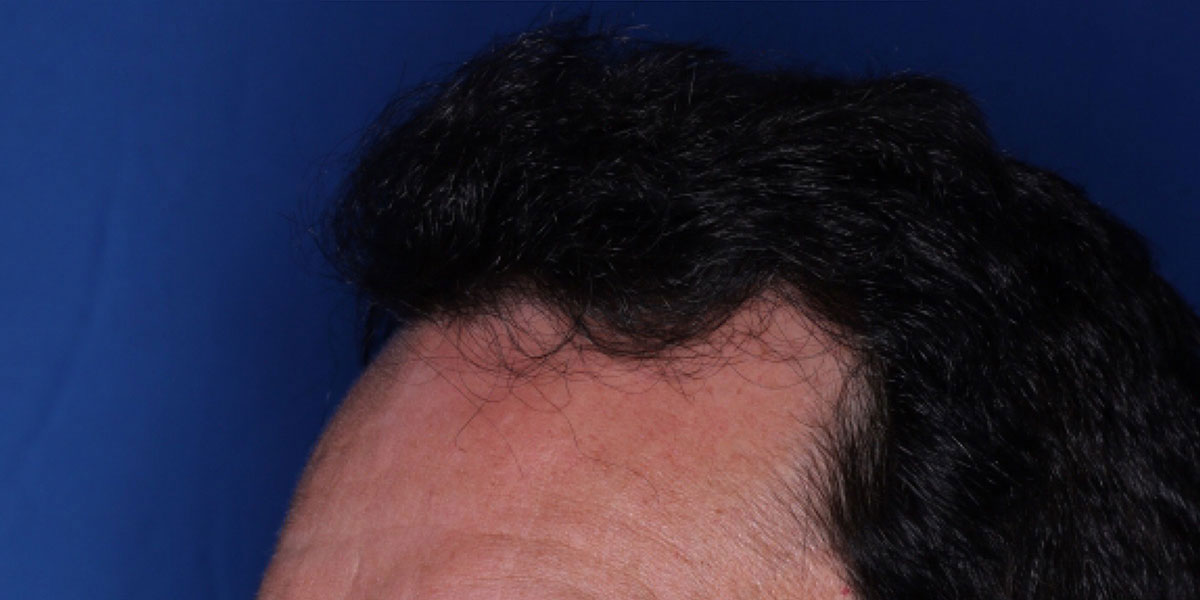after the hair transplant