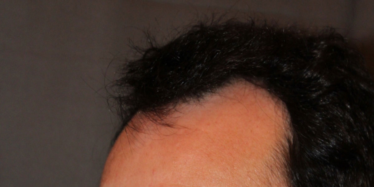 before the hair transplant