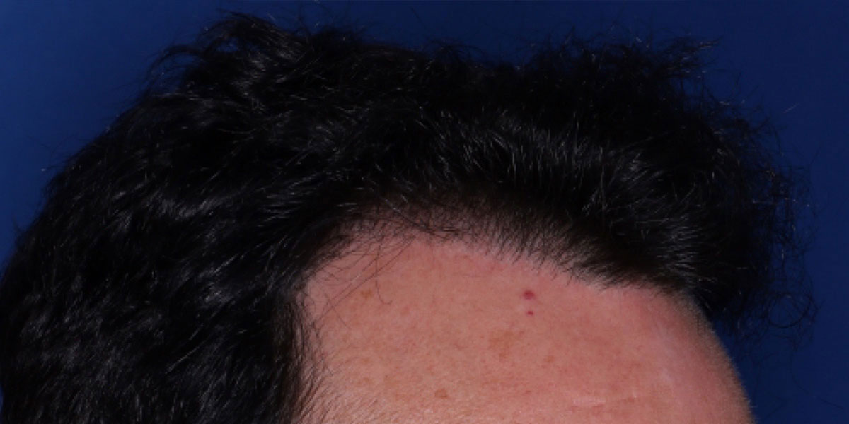 after the hair transplant