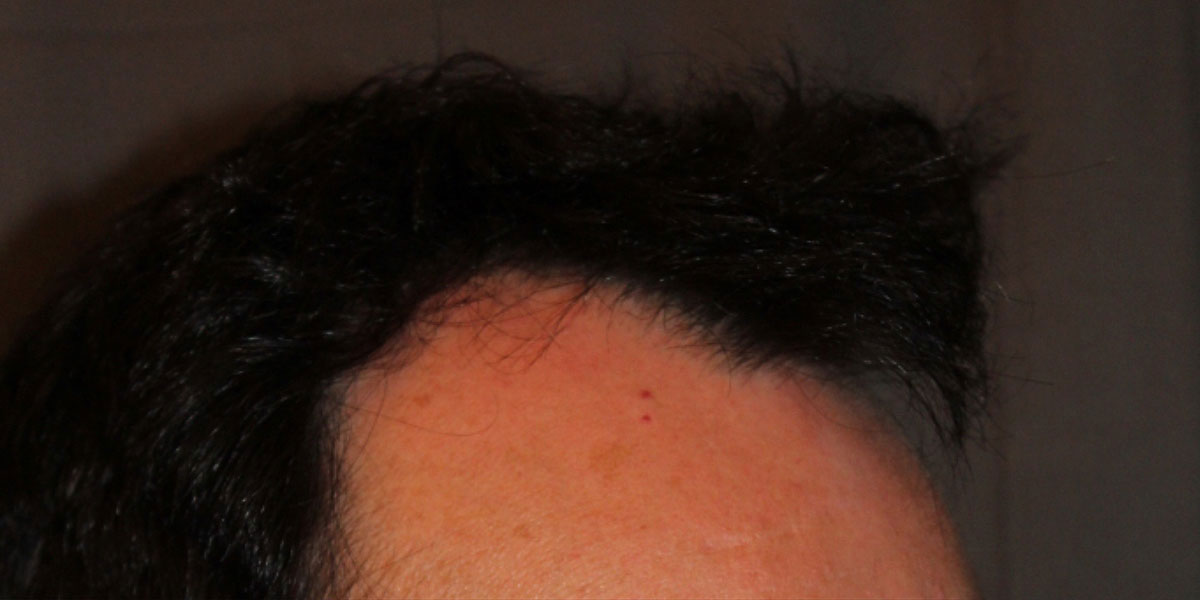 before the hair transplant
