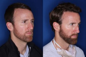 36 year old 8 months following 2500 grafts to frontal, temporal hair line