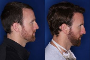 36 year old 8 months following 2500 grafts to frontal, temporal hair line