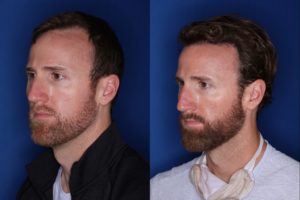 36 year old 8 months following 2500 grafts to frontal, temporal hair line