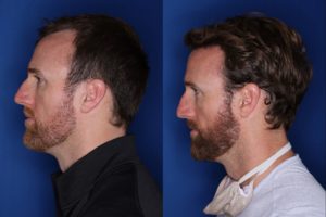 36 year old 8 months following 2500 grafts to frontal, temporal hair line
