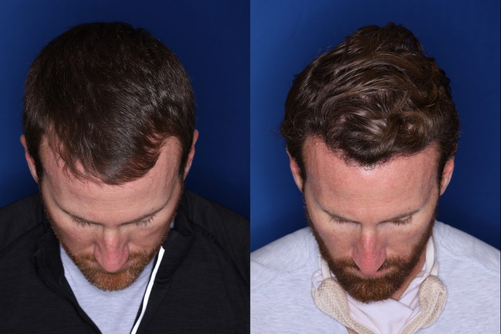 36 year old 8 months following 2500 grafts to frontal, temporal hair line