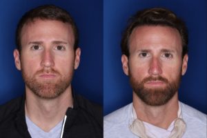 36 year old 8 months following 2500 grafts to frontal, temporal hair line