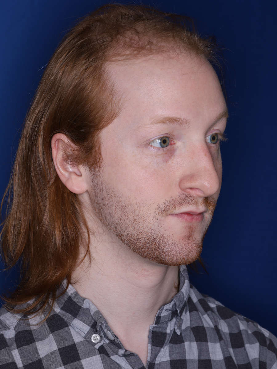 27 year old male 13 months following a 3000 graft hair transplant - before