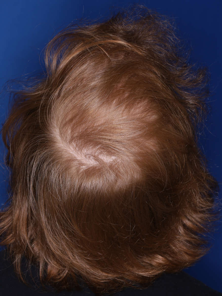 27 year old male 13 months following a 3000 graft hair transplant - after