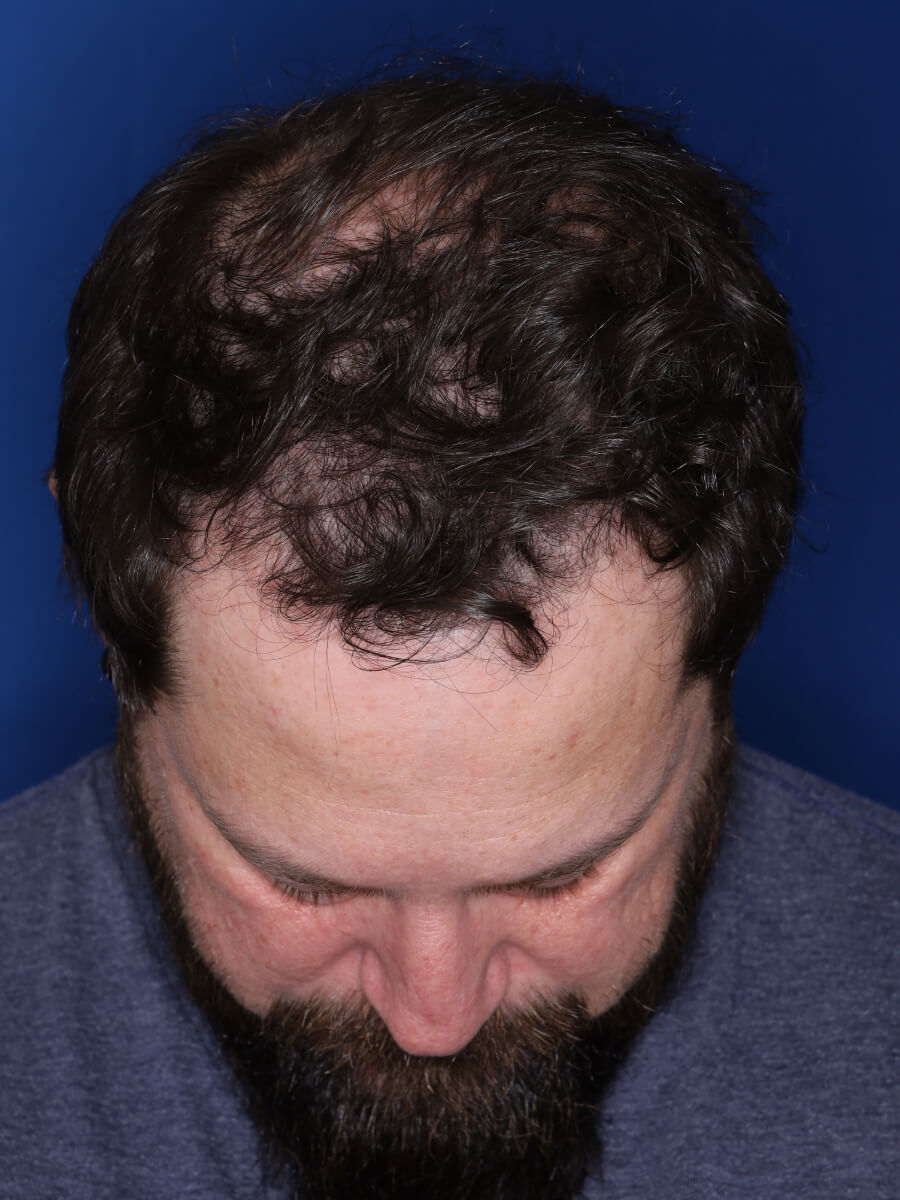 45 year old male 1 year post op from 3000 grafts throughout the entire scalp.