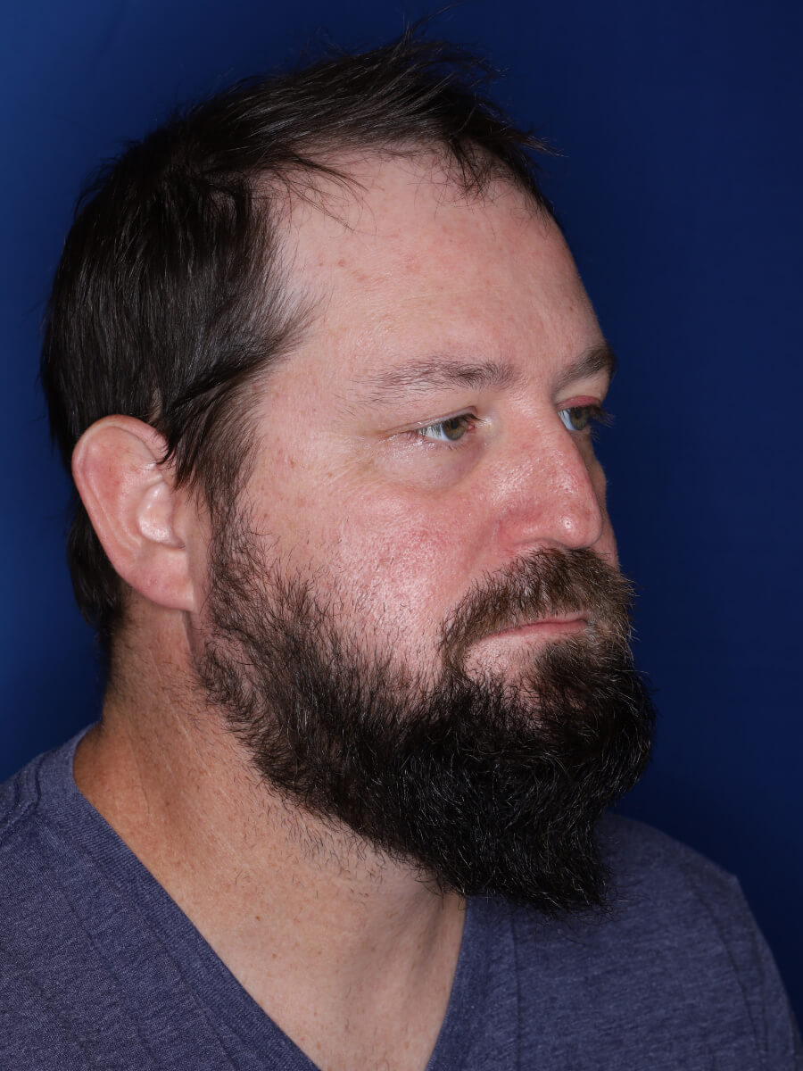 45 year old male 1 year post op from 3000 grafts throughout the entire scalp.