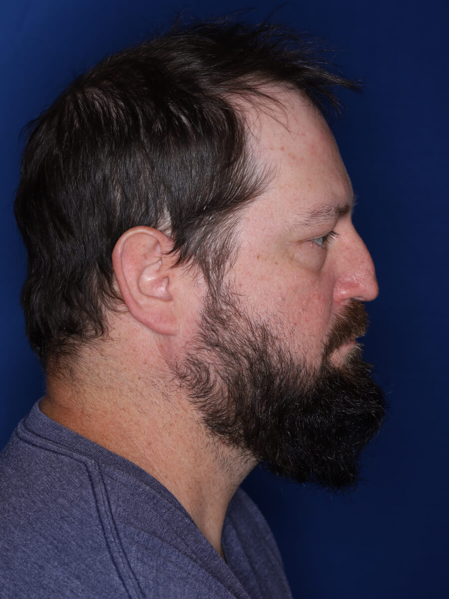 45 year old male 1 year post op from 3000 grafts throughout the entire scalp.