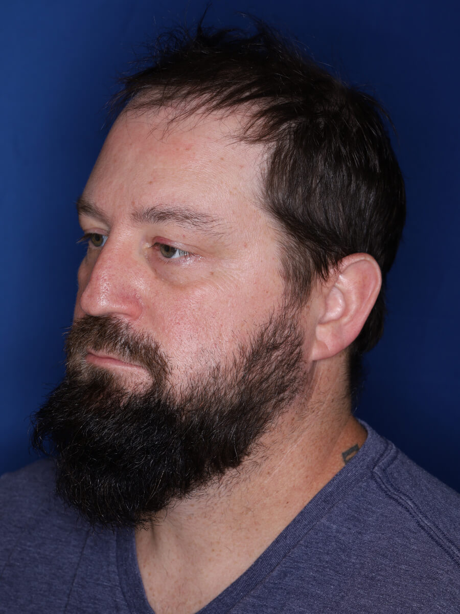 45 year old male 1 year post op from 3000 grafts throughout the entire scalp.