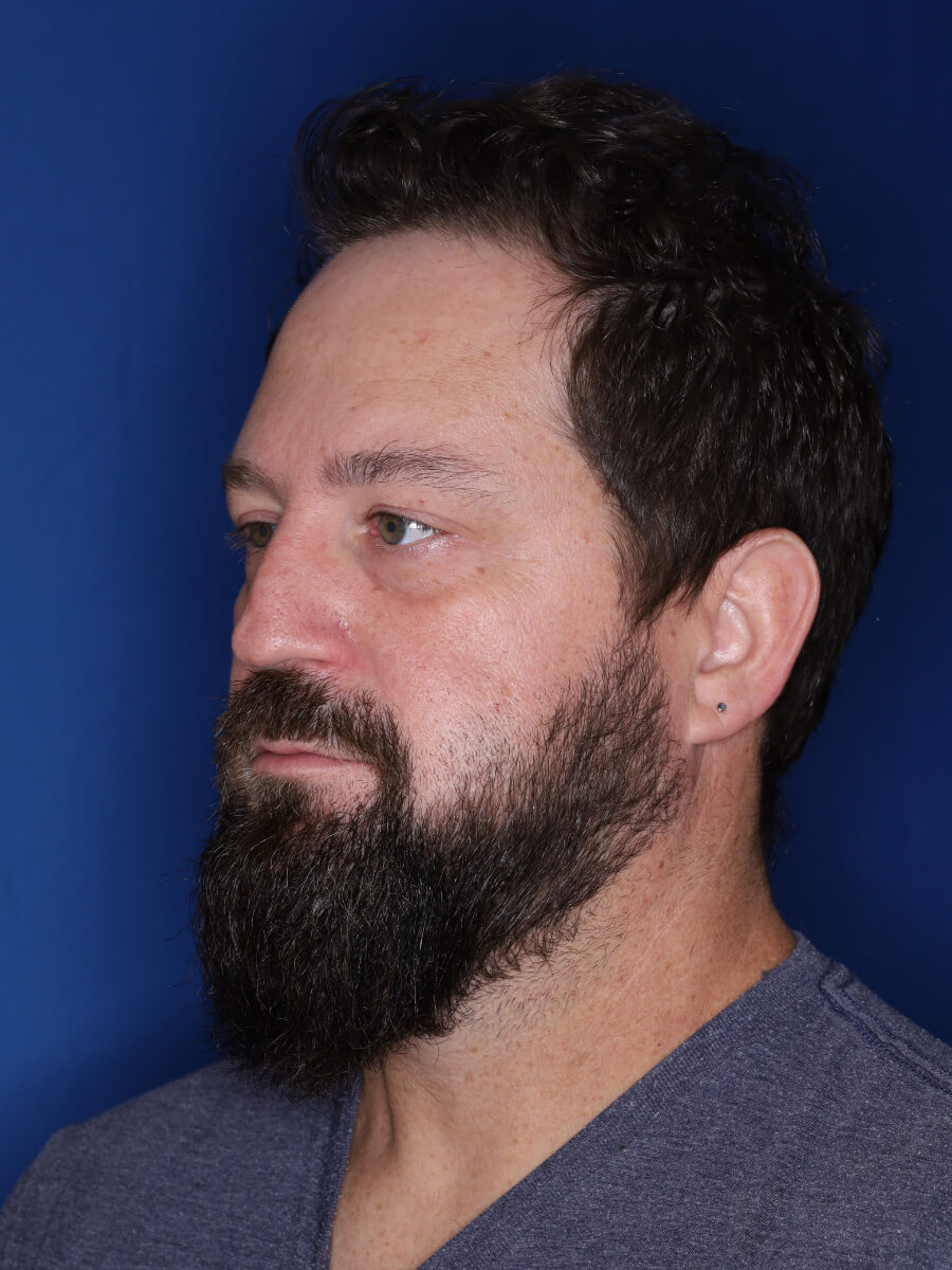 45 year old male 1 year post op from 3000 grafts throughout the entire scalp.
