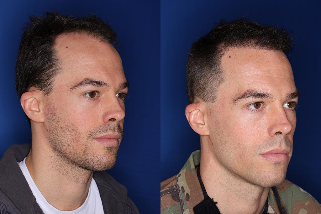 35 year old male 8 months following 2000 grafts to his frontal and temporal areas of hair loss.