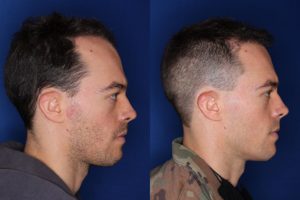 35 year old male 8 months following 2000 grafts to his frontal and temporal areas of hair loss.
