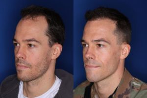 35 year old male 8 months following 2000 grafts to his frontal and temporal areas of hair loss.