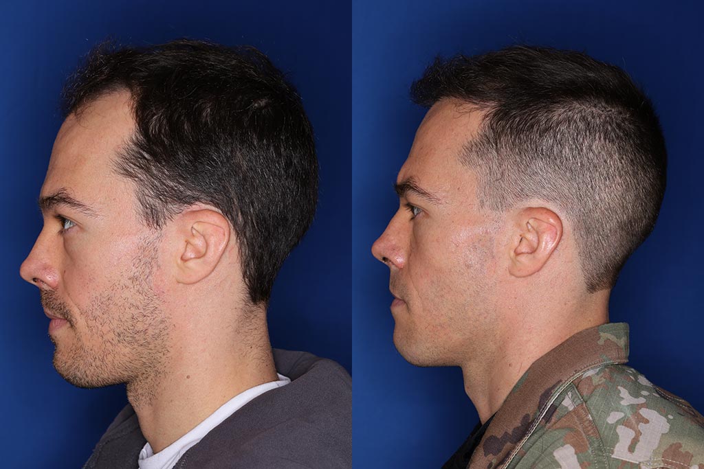 35 year old male 8 months following 2000 grafts to his frontal and temporal areas of hair loss.