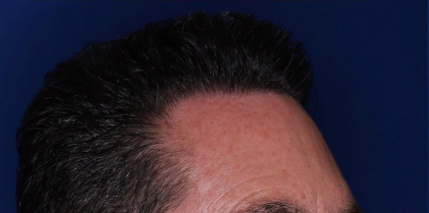 52 year old male 8 months following 2000 grafts to restore frontal temporal hair loss