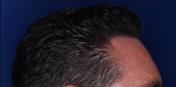 52 year old male 8 months following 2000 grafts to restore frontal temporal hair loss